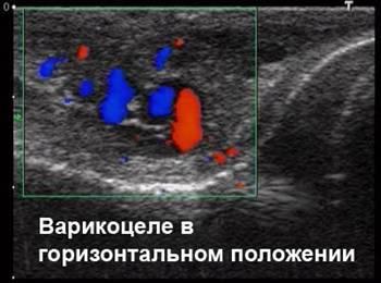 Варикоцеле у мужчин - как лечить? МЦ Формула здоровья